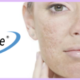 laser acne scar treatment birmingham mi