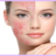 laser acne treatment birmingham mi