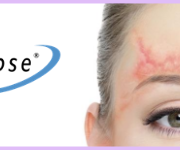laser scar removal treatment birmingham mi