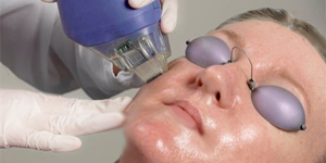 fraxel anti-aging skin resurfacing treatments birmingham MI