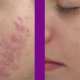 teen acne treatment birmingham