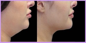 CoolSculpting Neck: Fast, Non-Invasive Double Chin Removal