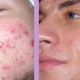 dermalinfusion acne treatment