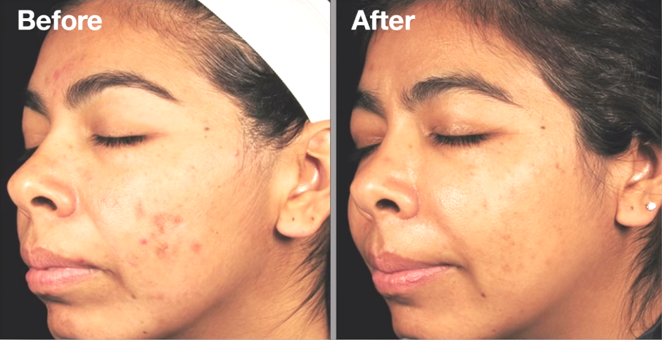 All About The Dermal Infusion Process Dustbowl Adventure All About The Dermal Infusion Process Dustbowl Adventure
