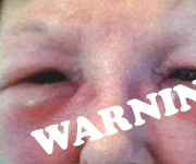 cheap facial fillers