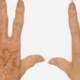 ipl hand age spots